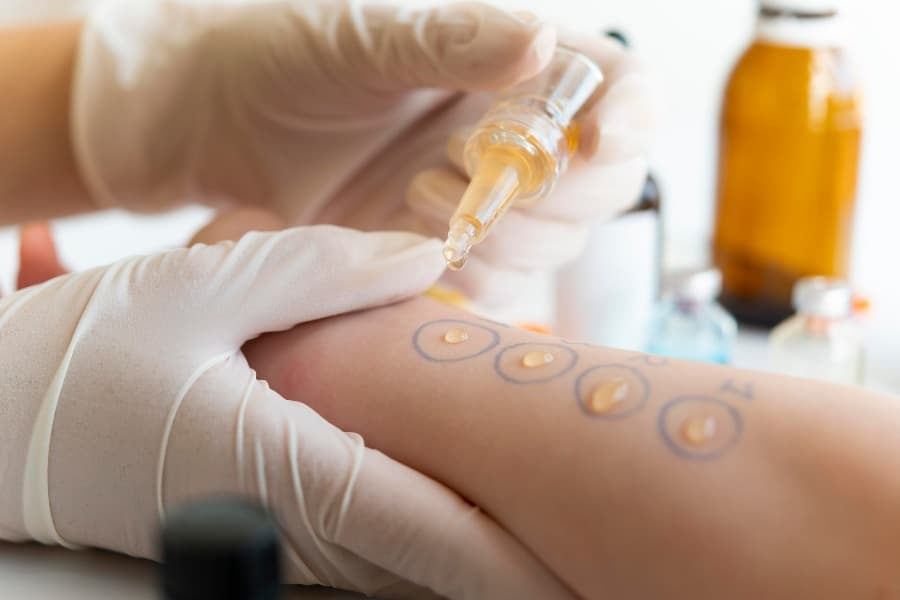Discovering the Benefits of Allergy Testing